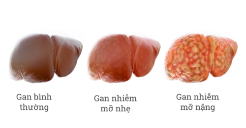 Bệnh gan nhiễm mỡ